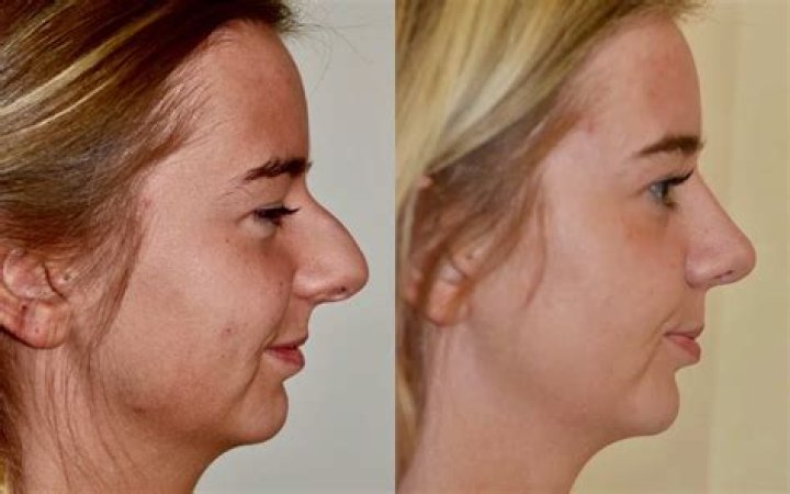Carrie Ann Inaba's Rhinoplasty: Transformation And Impact