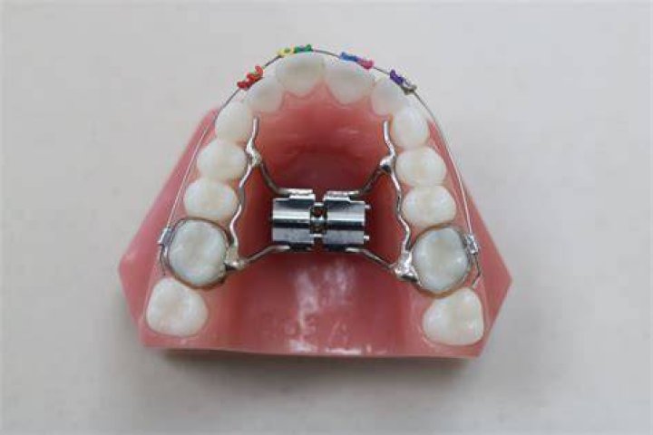 Palatal Expander Orthodontics by Steve Chapman