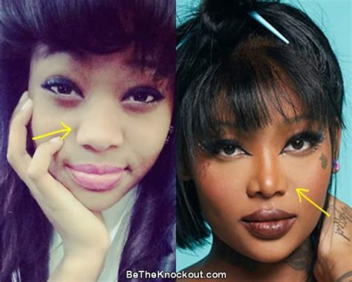 Summer Walker Before Plastic Surgery