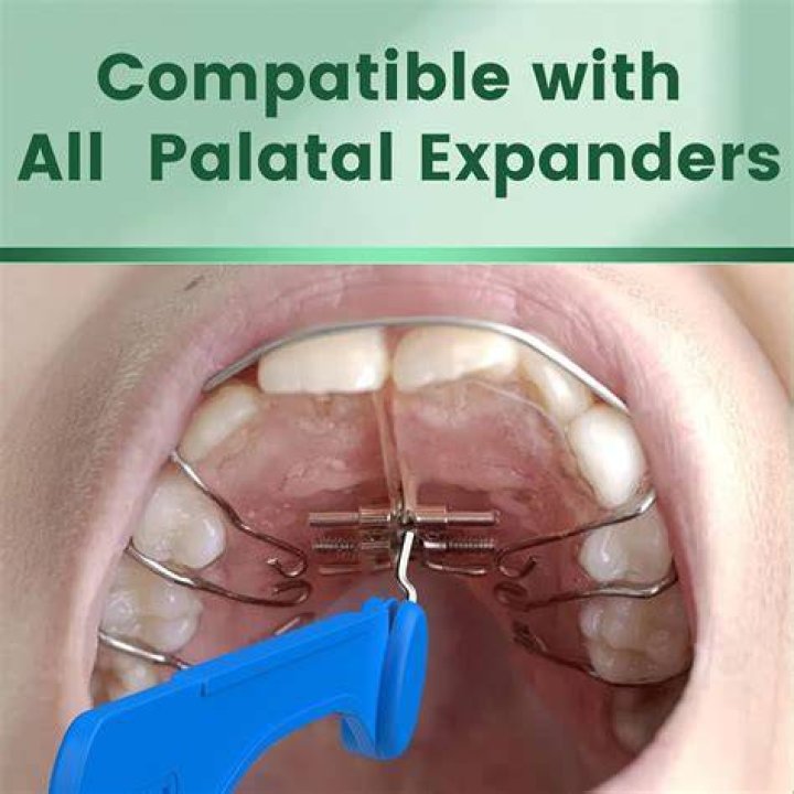 The Ultimate Palate Expander Guide: Find The Best On Amazon