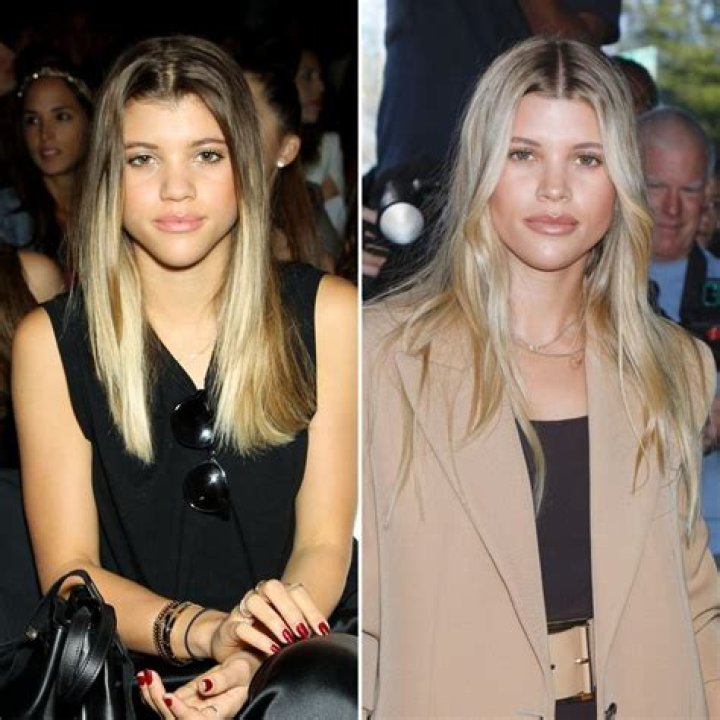 Unveiling The Truth Behind Sofia Richie's Surgery: Discoveries And Insights